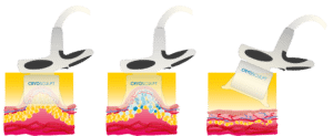 Appareil CryoSculpt illustrant le processus de traitement esthétique pour la réduction des graisses.