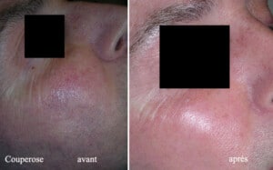 Résultats d'un traitement de couperose : avant et après, montrant une amélioration de l'apparence de la peau.