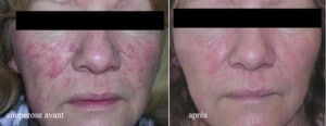 Comparaison du visage d'une patiente avec couperose avant et après traitement esthétique.