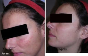 Avant et après un traitement esthétique du visage montrant une amélioration de la peau.