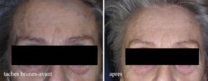 Avant-après d'un traitement esthétiques sur le visage, montrant l'amélioration des taches brunes.