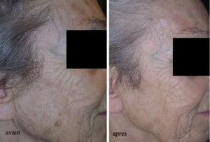 Comparaison des résultats d'un traitement anti-âge : avant et après sur le visage d'une patiente.