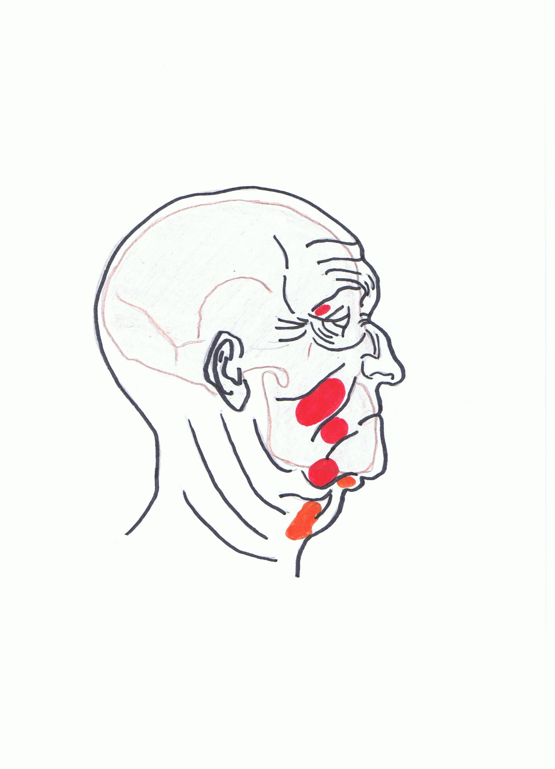 Illustration d’un visage en profil avec des zones rouges indiquant des traitements esthétiques.