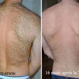 Résultat avant-après d’une épilation laser du dos à seize mois.