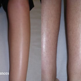 Résultat avant-après d’une épilation laser des jambes.