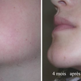 Résultat avant-après d’une épilation laser du visage.