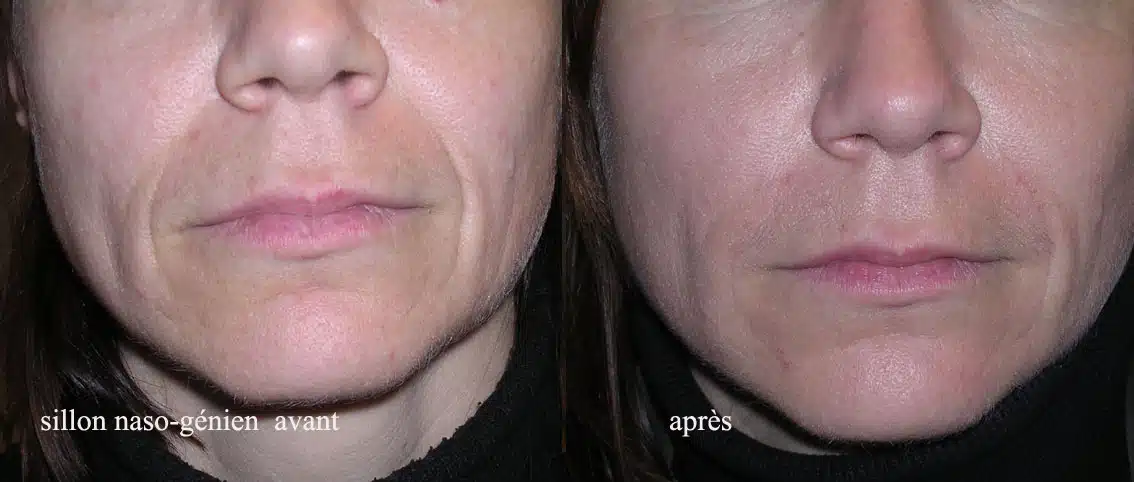 Avant et après traitement des sillons nasogéniens sur le visage d’une patiente.