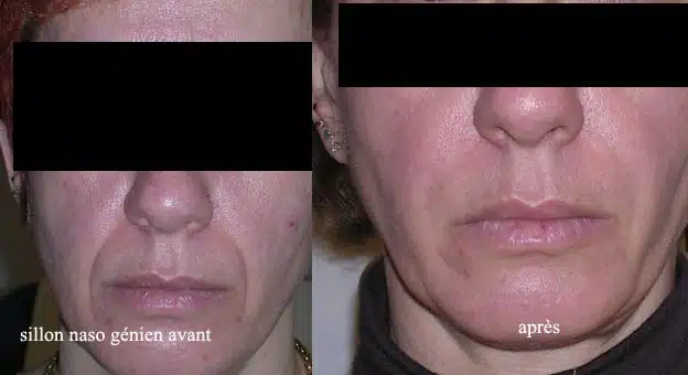 Avant et après traitement esthétique du sillon naso-génien, montrant une amélioration visible de la peau.