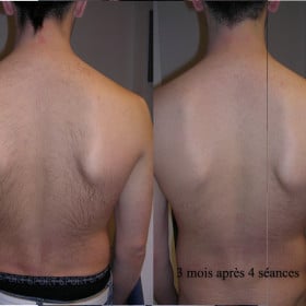 Résultat avant-après d’une épilation laser du dos après quatre séances.